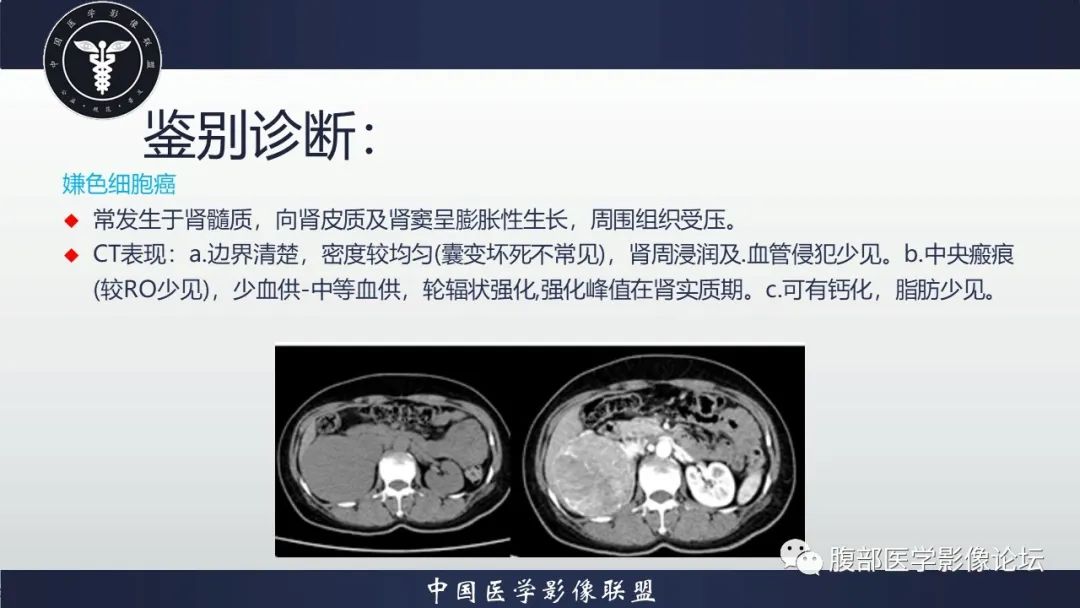 影像PPT - 【病例】肾脏嗜酸细胞腺瘤-11