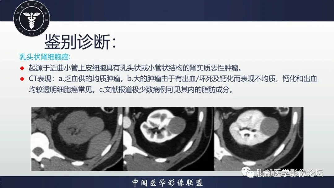 影像PPT - 【病例】肾脏嗜酸细胞腺瘤-13