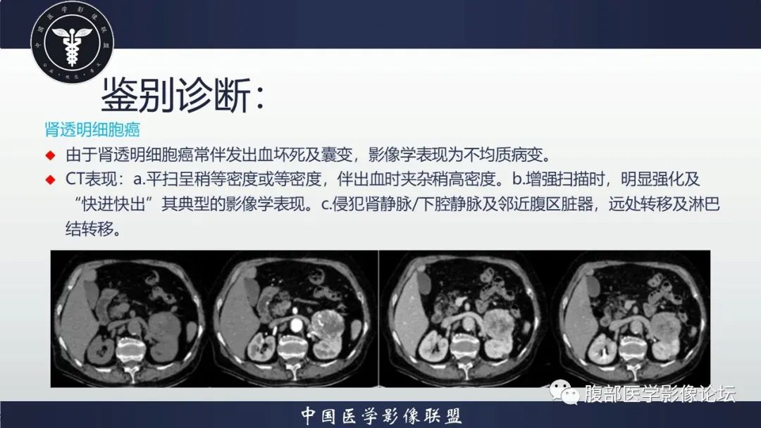 影像PPT - 【病例】肾脏嗜酸细胞腺瘤-12