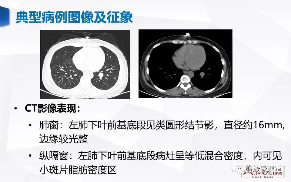 影像PPT - 【病例】肺错构瘤 VS 肺硬化性血管瘤-4