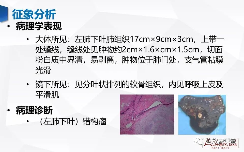 影像PPT - 【病例】肺错构瘤 VS 肺硬化性血管瘤-6