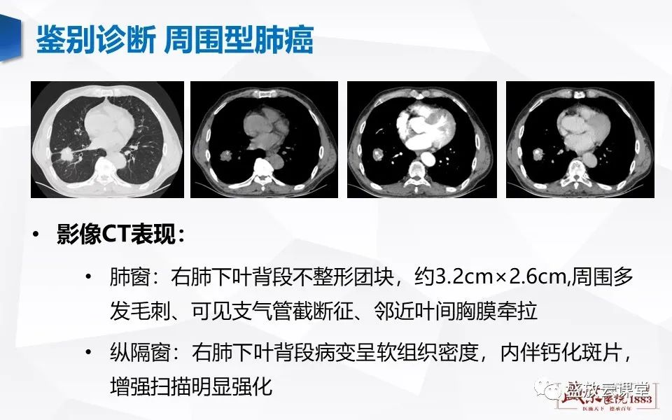影像PPT - 【病例】肺错构瘤 VS 肺硬化性血管瘤-12