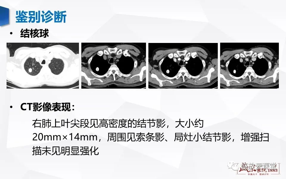 影像PPT - 【病例】肺错构瘤 VS 肺硬化性血管瘤-15