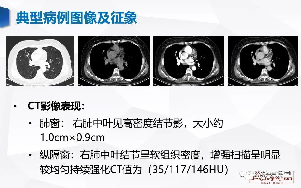 影像PPT - 【病例】肺错构瘤 VS 肺硬化性血管瘤-21