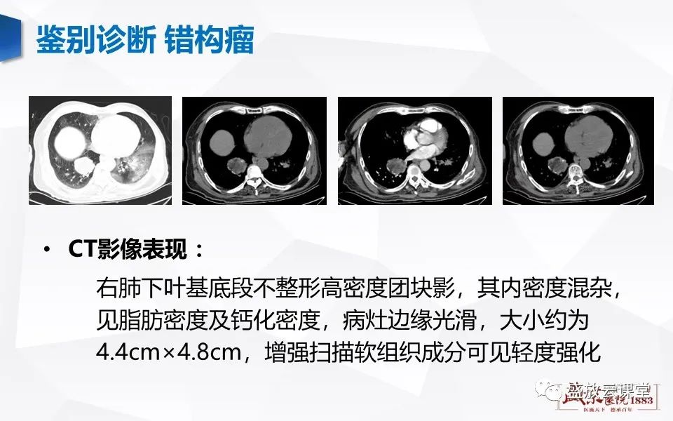 影像PPT - 【病例】肺错构瘤 VS 肺硬化性血管瘤-26