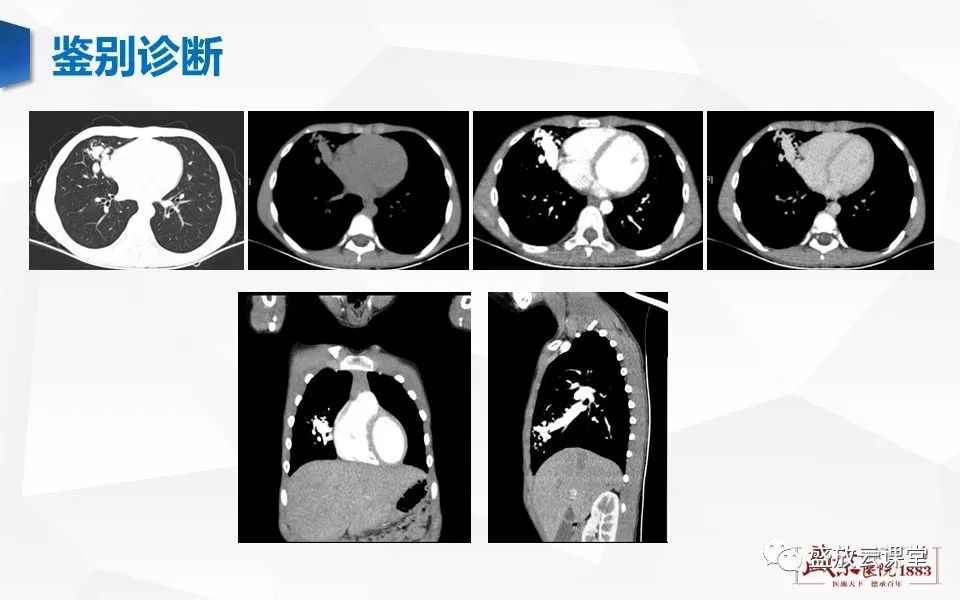 影像PPT - 【病例】肺错构瘤 VS 肺硬化性血管瘤-28