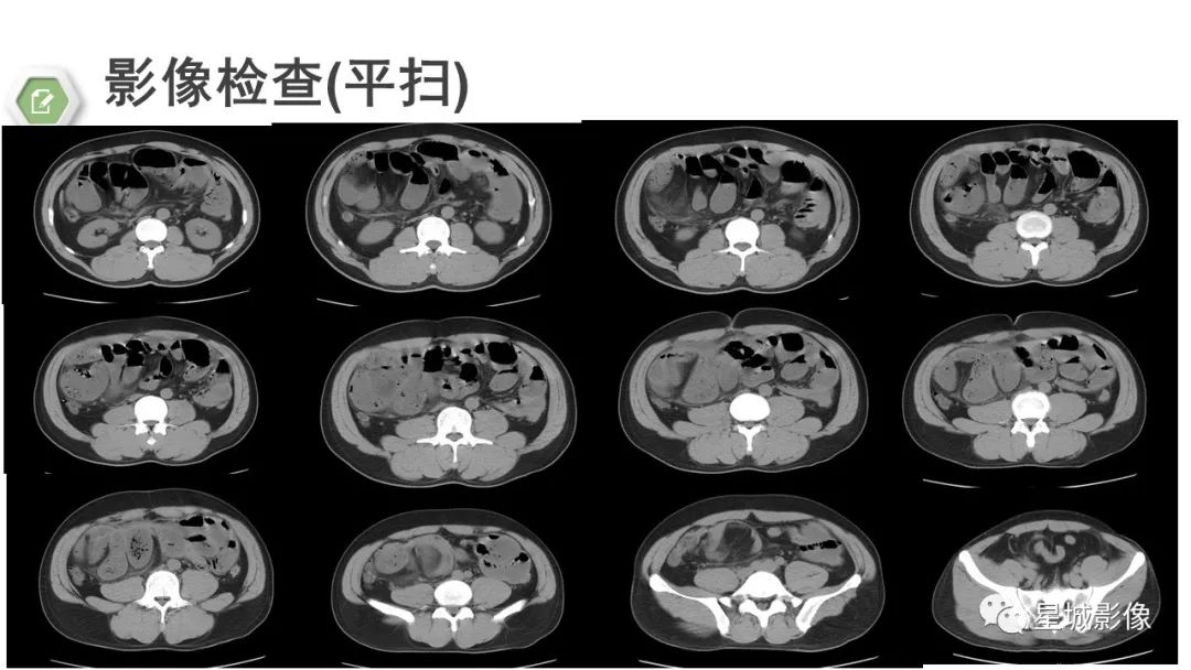 影像PPT - 【病例】腹茧症1例影像表现-5