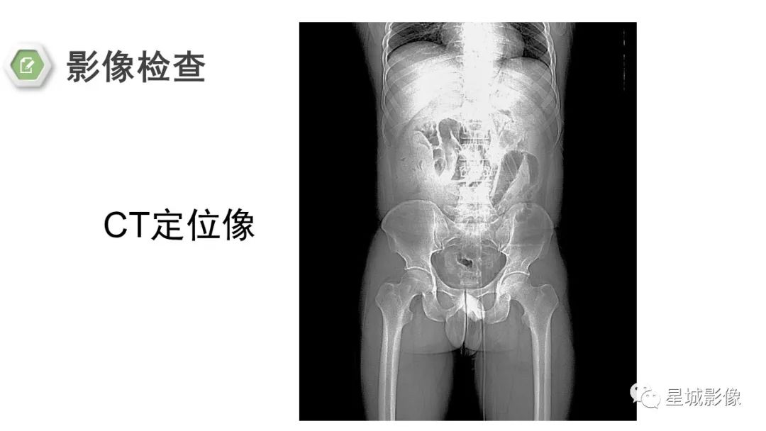 影像PPT - 【病例】腹茧症1例影像表现-4