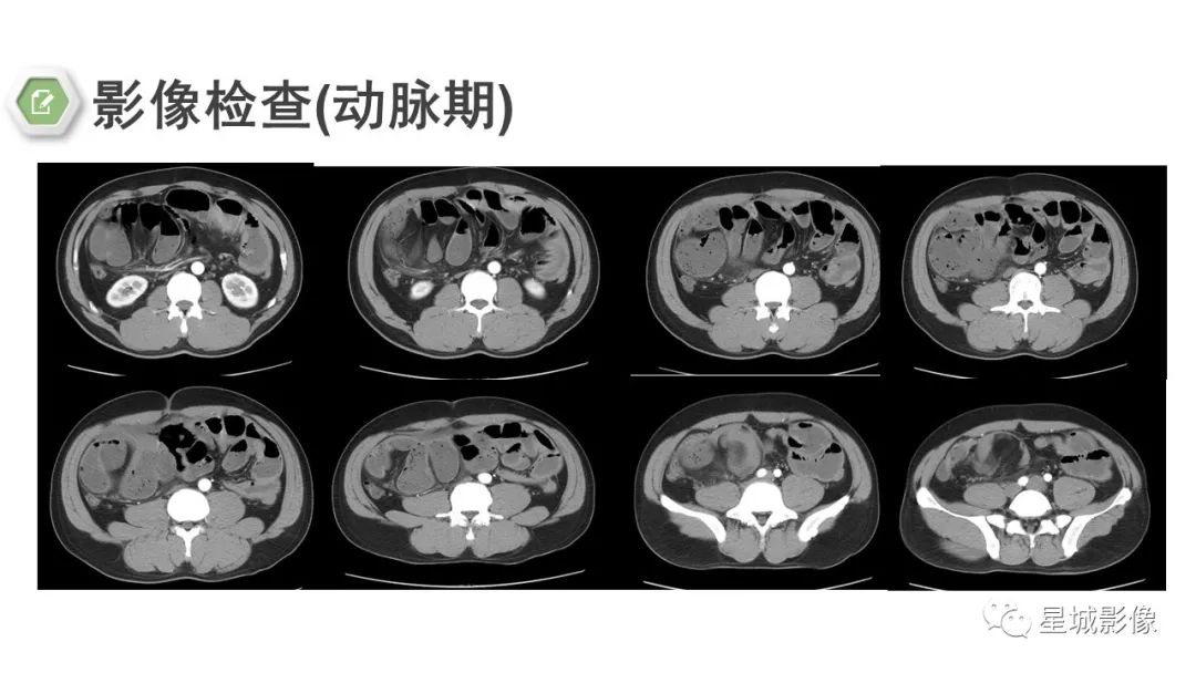 影像PPT - 【病例】腹茧症1例影像表现-6