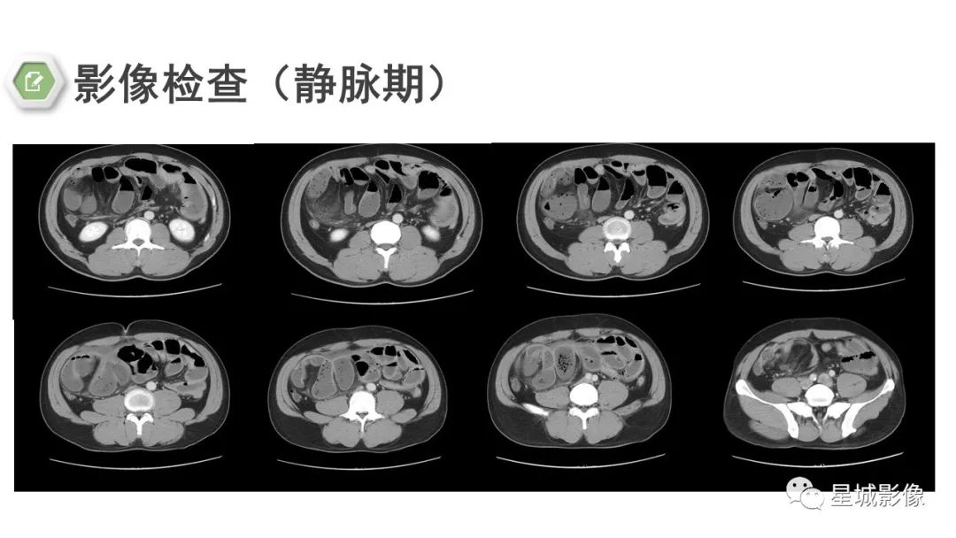 影像PPT - 【病例】腹茧症1例影像表现-7