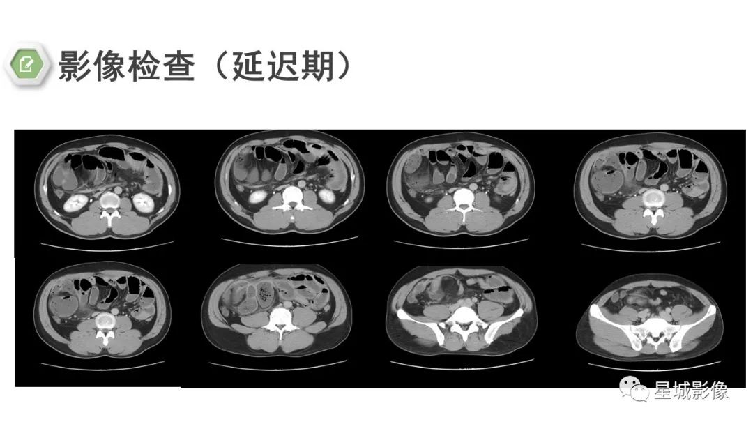 影像PPT - 【病例】腹茧症1例影像表现-8