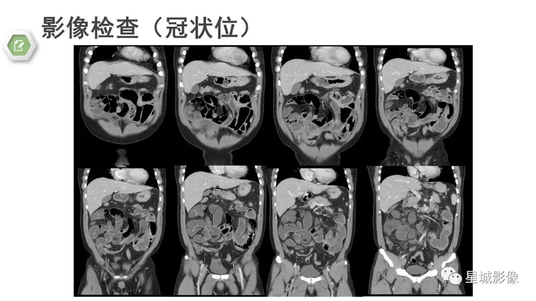 影像PPT - 【病例】腹茧症1例影像表现-9