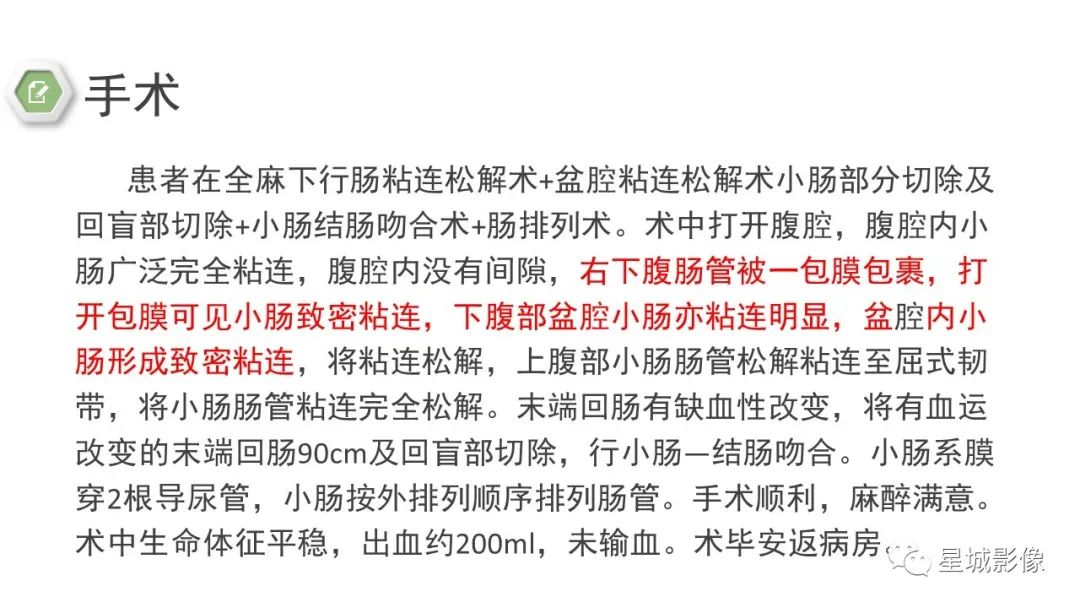 影像PPT - 【病例】腹茧症1例影像表现-11