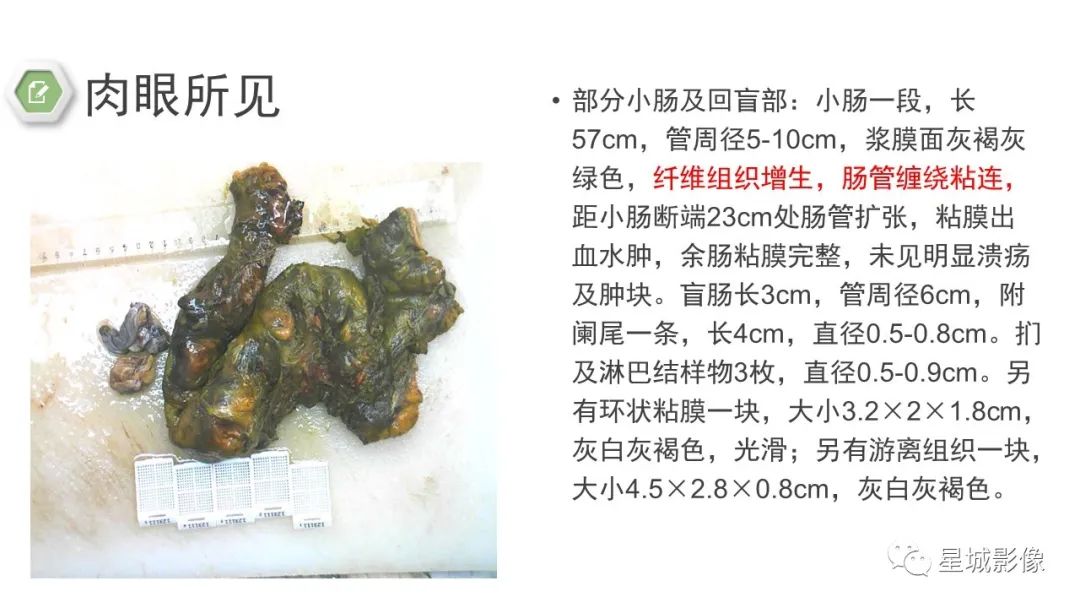 影像PPT - 【病例】腹茧症1例影像表现-12