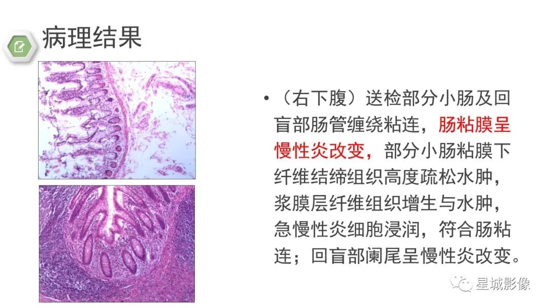 影像PPT - 【病例】腹茧症1例影像表现-13