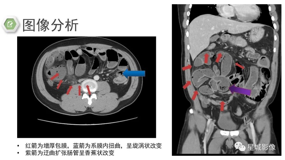 影像PPT - 【病例】腹茧症1例影像表现-20