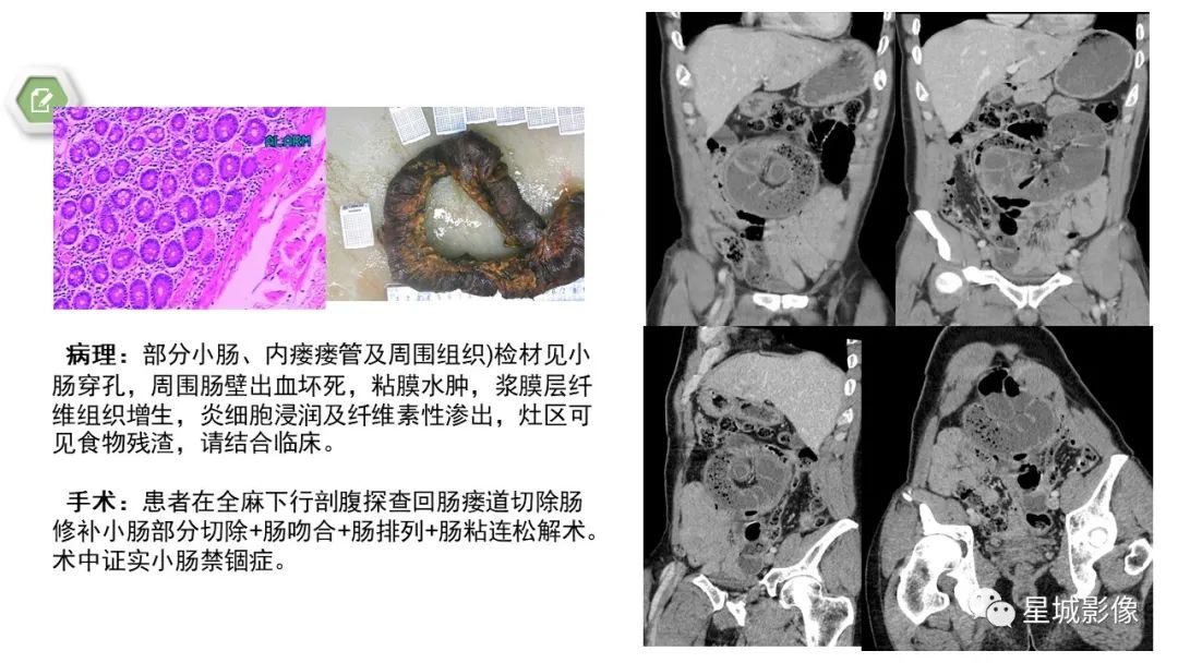 影像PPT - 【病例】腹茧症1例影像表现-22