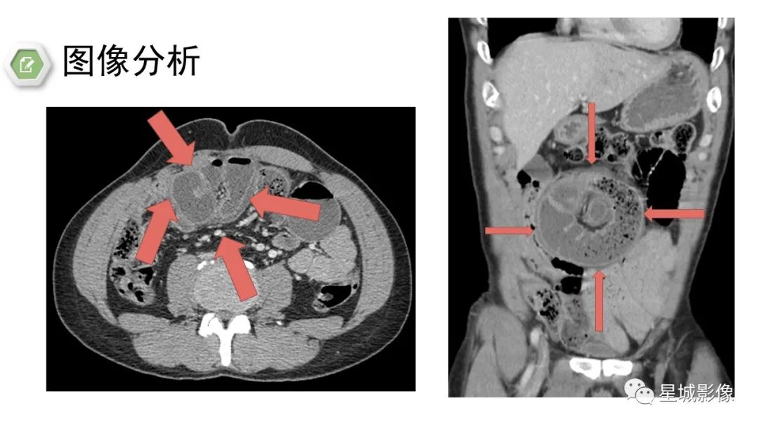影像PPT - 【病例】腹茧症1例影像表现-23
