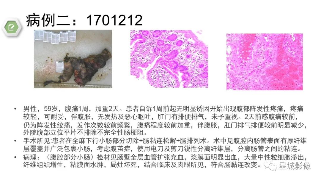 影像PPT - 【病例】腹茧症1例影像表现-24