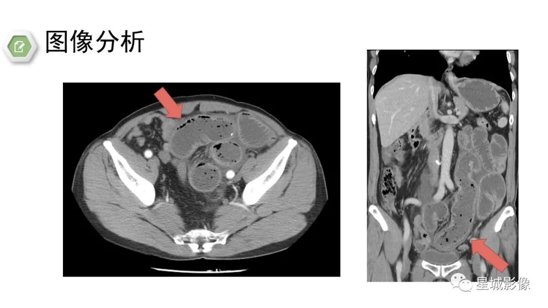 影像PPT - 【病例】腹茧症1例影像表现-26