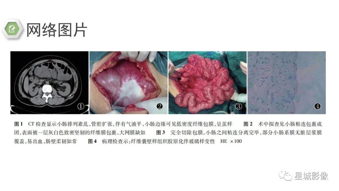 影像PPT - 【病例】腹茧症1例影像表现-27