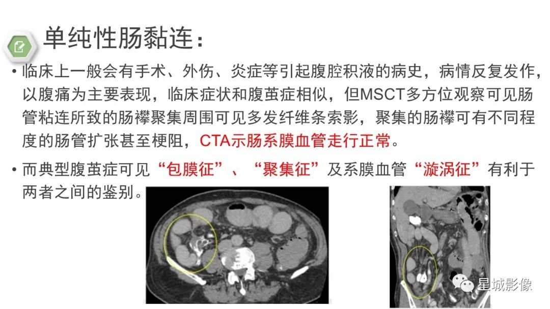 影像PPT - 【病例】腹茧症1例影像表现-29