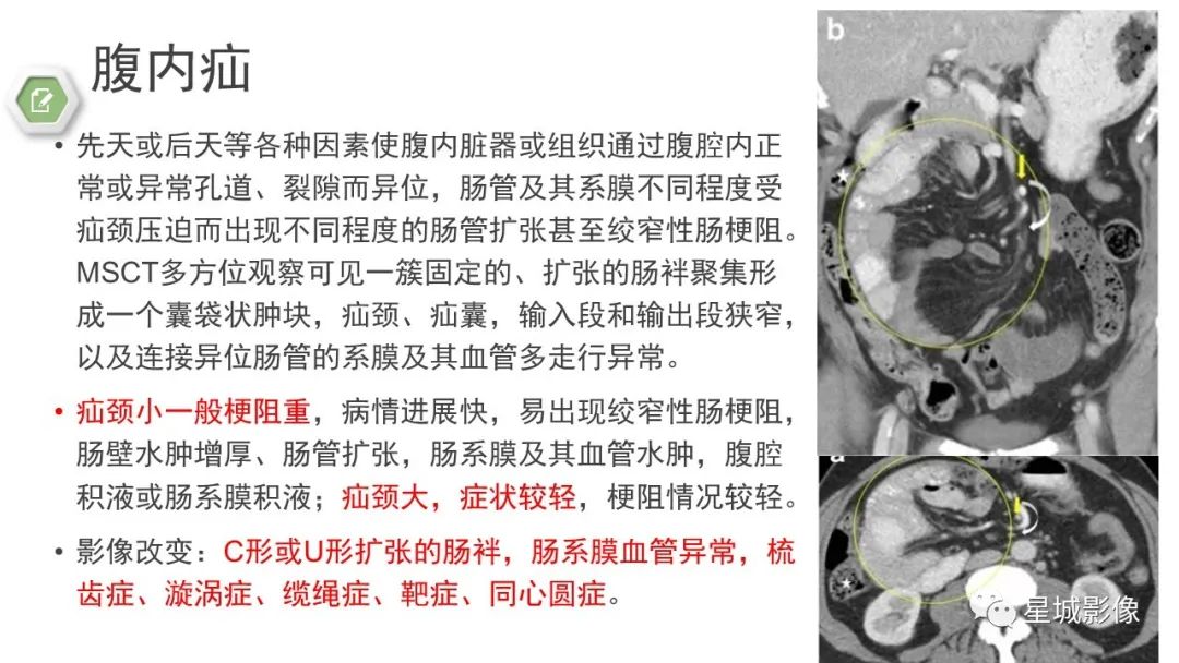 影像PPT - 【病例】腹茧症1例影像表现-30