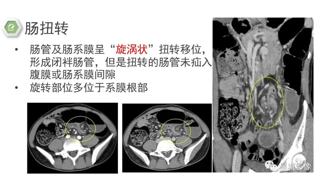 影像PPT - 【病例】腹茧症1例影像表现-32