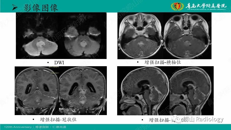 影像PPT - 【病例】髓母细胞瘤1例CT及MR-4
