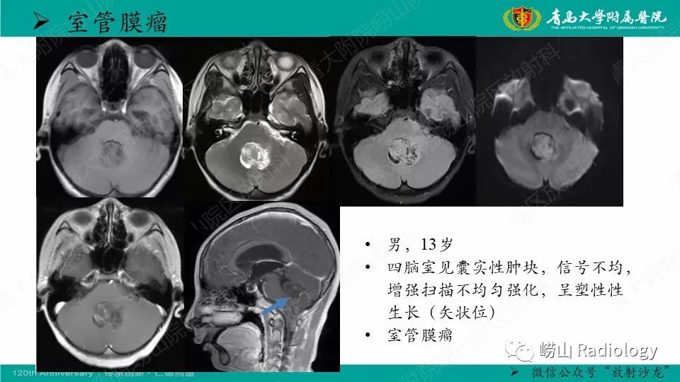 影像PPT - 【病例】髓母细胞瘤1例CT及MR-11