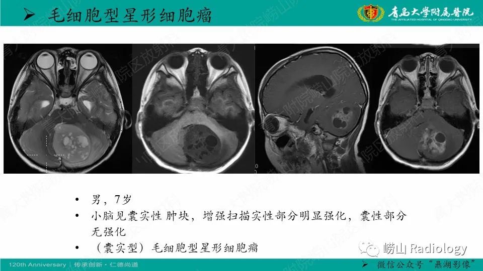 影像PPT - 【病例】髓母细胞瘤1例CT及MR-13