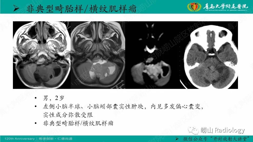 影像PPT - 【病例】髓母细胞瘤1例CT及MR-15