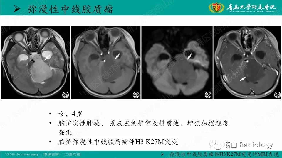 影像PPT - 【病例】髓母细胞瘤1例CT及MR-17