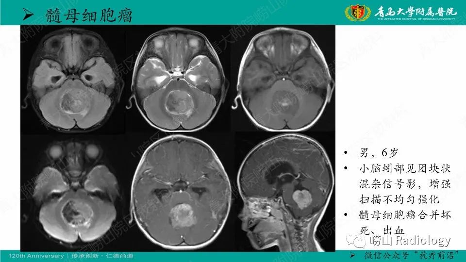 影像PPT - 【病例】髓母细胞瘤1例CT及MR-19