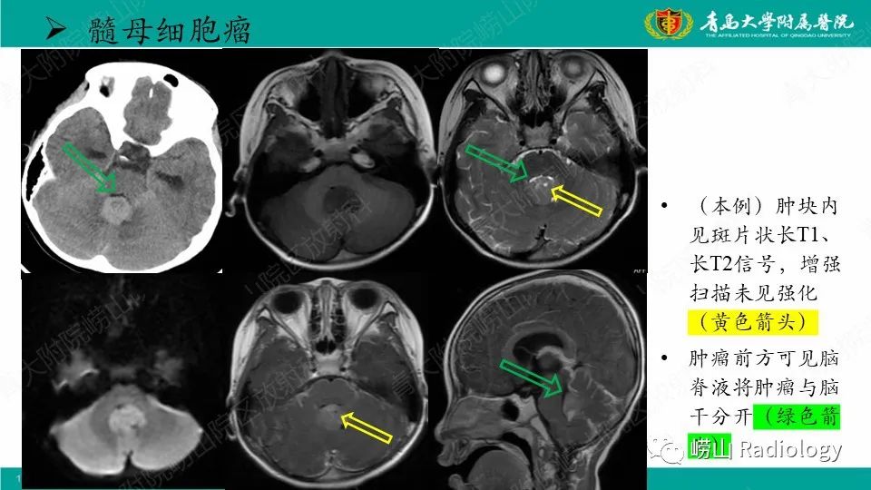 影像PPT - 【病例】髓母细胞瘤1例CT及MR-27