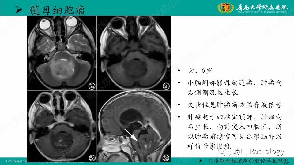 影像PPT - 【病例】髓母细胞瘤1例CT及MR-28