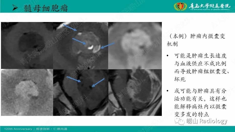 影像PPT - 【病例】髓母细胞瘤1例CT及MR-29
