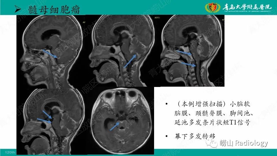 影像PPT - 【病例】髓母细胞瘤1例CT及MR-30