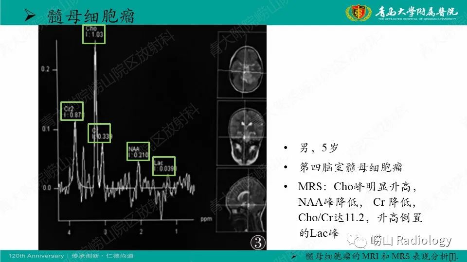影像PPT - 【病例】髓母细胞瘤1例CT及MR-26