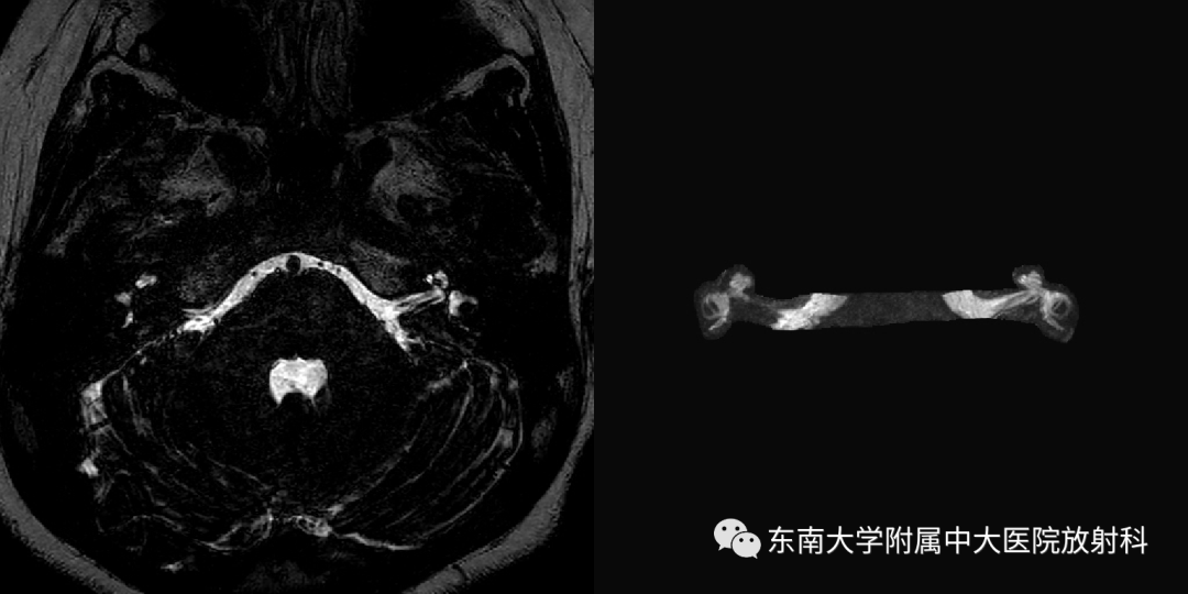 影像PPT - 【PPT】蜗神经发育不良-2 影像PPT - 【PPT】蜗神经发育不良-2