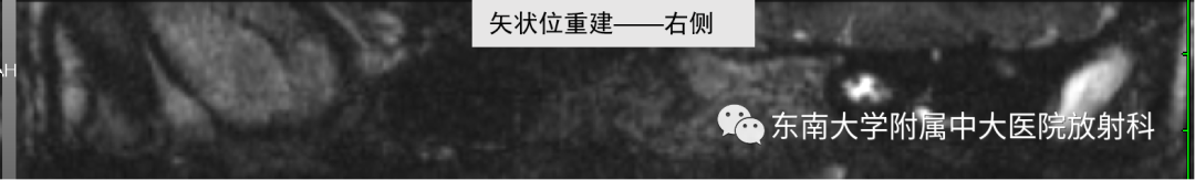 影像PPT - 【PPT】蜗神经发育不良-4 影像PPT - 【PPT】蜗神经发育不良-4