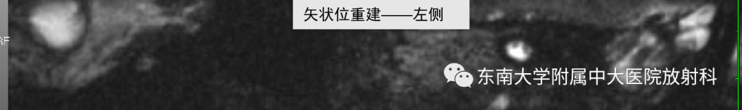 影像PPT - 【PPT】蜗神经发育不良-5 影像PPT - 【PPT】蜗神经发育不良-5