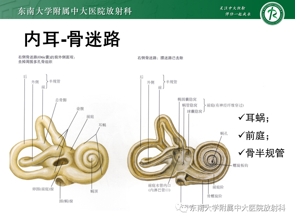 影像PPT - 【PPT】蜗神经发育不良-12 影像PPT - 【PPT】蜗神经发育不良-12