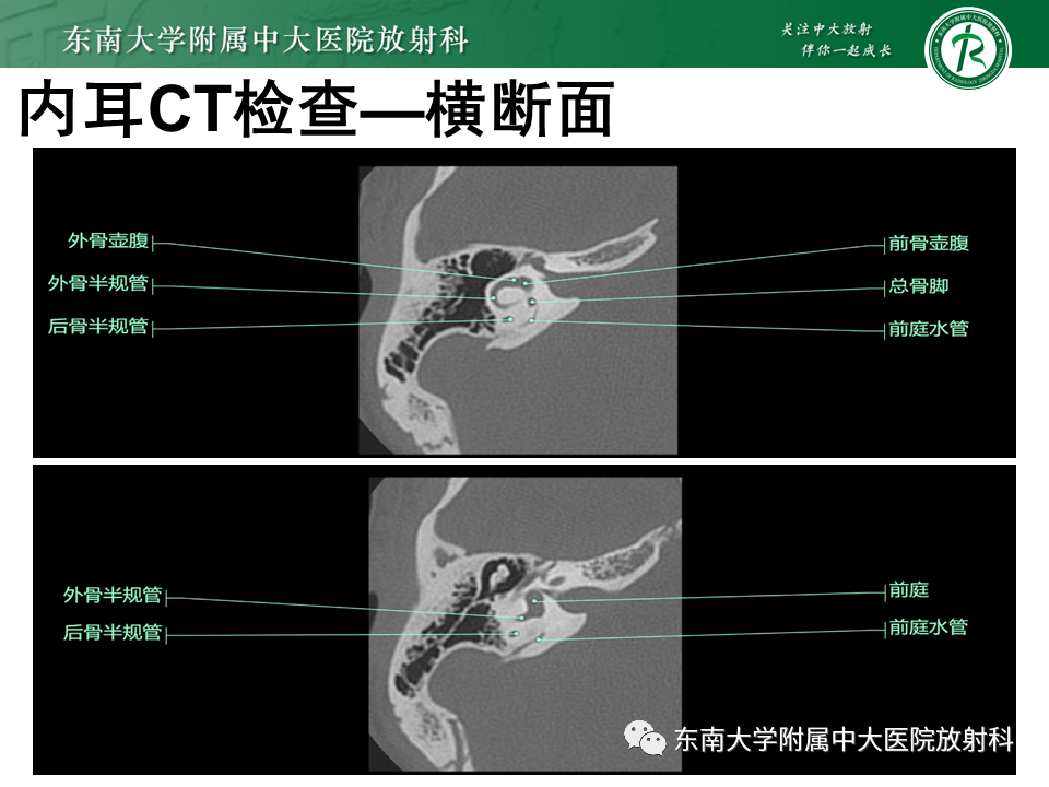 影像PPT - 【PPT】蜗神经发育不良-15 影像PPT - 【PPT】蜗神经发育不良-15