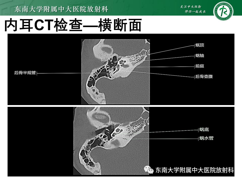 影像PPT - 【PPT】蜗神经发育不良-16 影像PPT - 【PPT】蜗神经发育不良-16