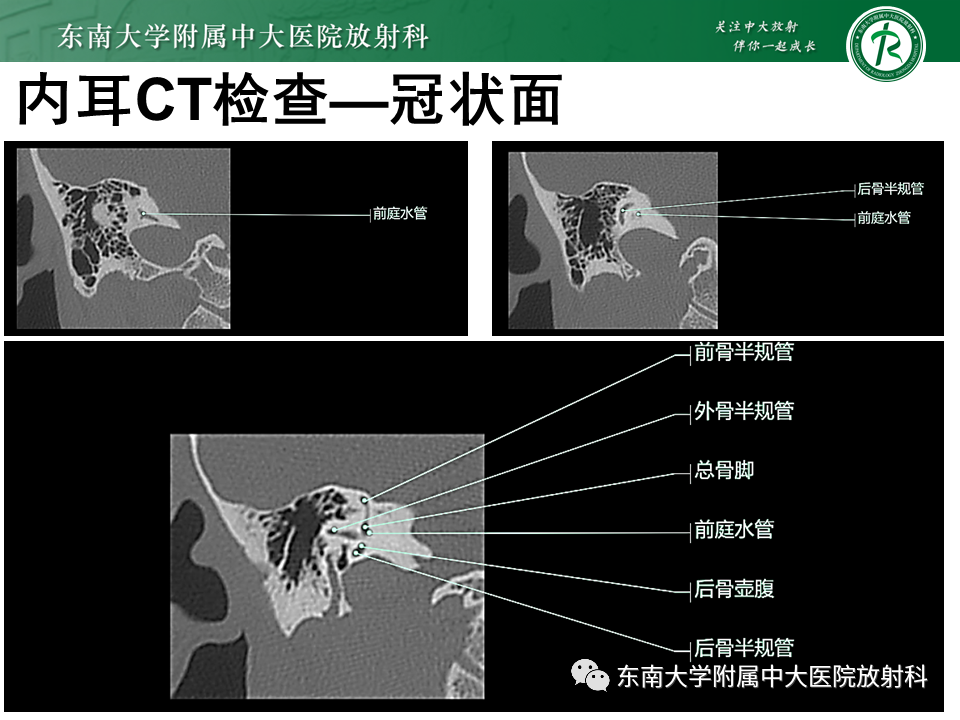 影像PPT - 【PPT】蜗神经发育不良-17 影像PPT - 【PPT】蜗神经发育不良-17