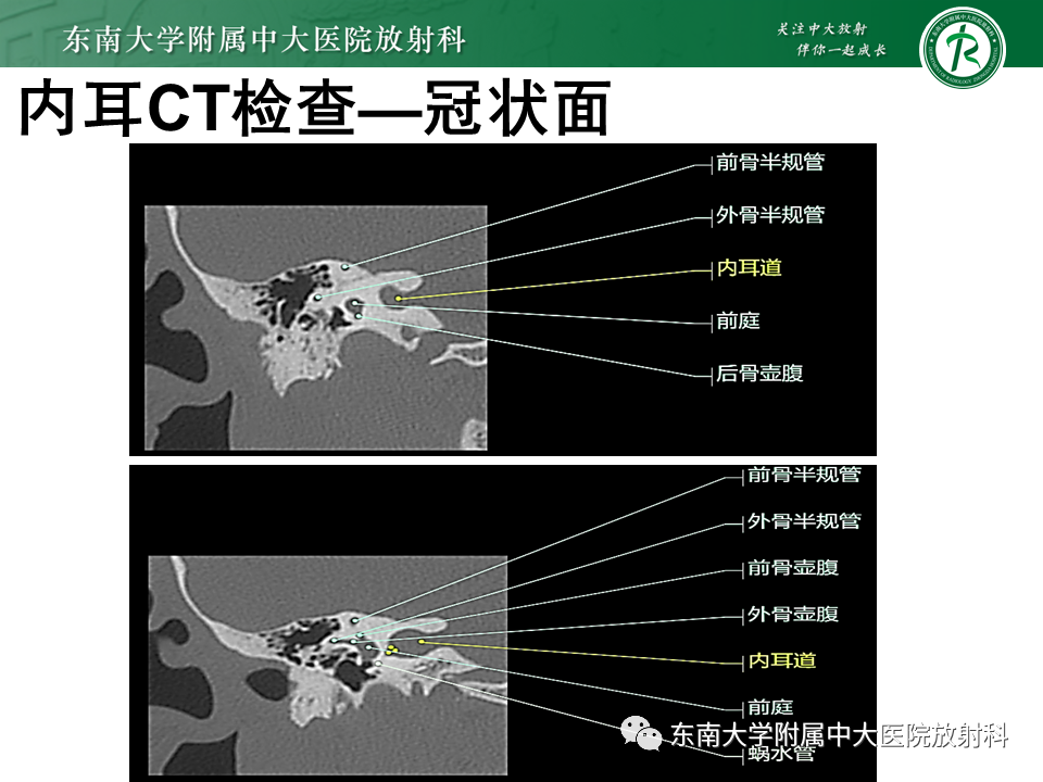 影像PPT - 【PPT】蜗神经发育不良-18 影像PPT - 【PPT】蜗神经发育不良-18
