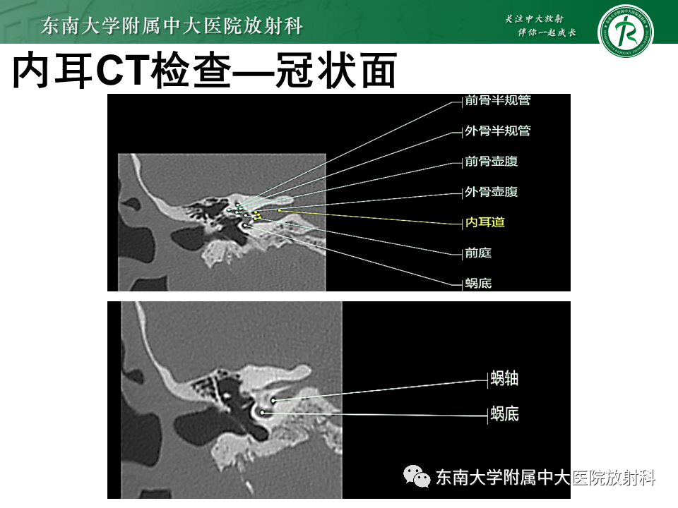 影像PPT - 【PPT】蜗神经发育不良-19 影像PPT - 【PPT】蜗神经发育不良-19