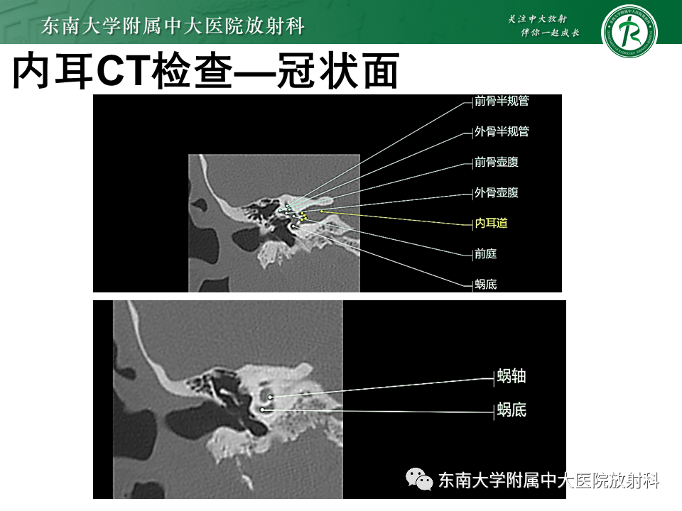 影像PPT - 【PPT】蜗神经发育不良-20 影像PPT - 【PPT】蜗神经发育不良-20