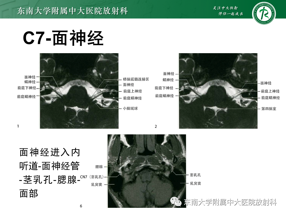 影像PPT - 【PPT】蜗神经发育不良-21 影像PPT - 【PPT】蜗神经发育不良-21